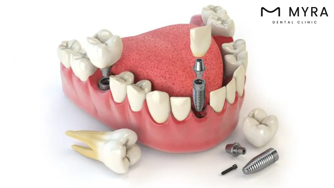 timing dental implant.webp